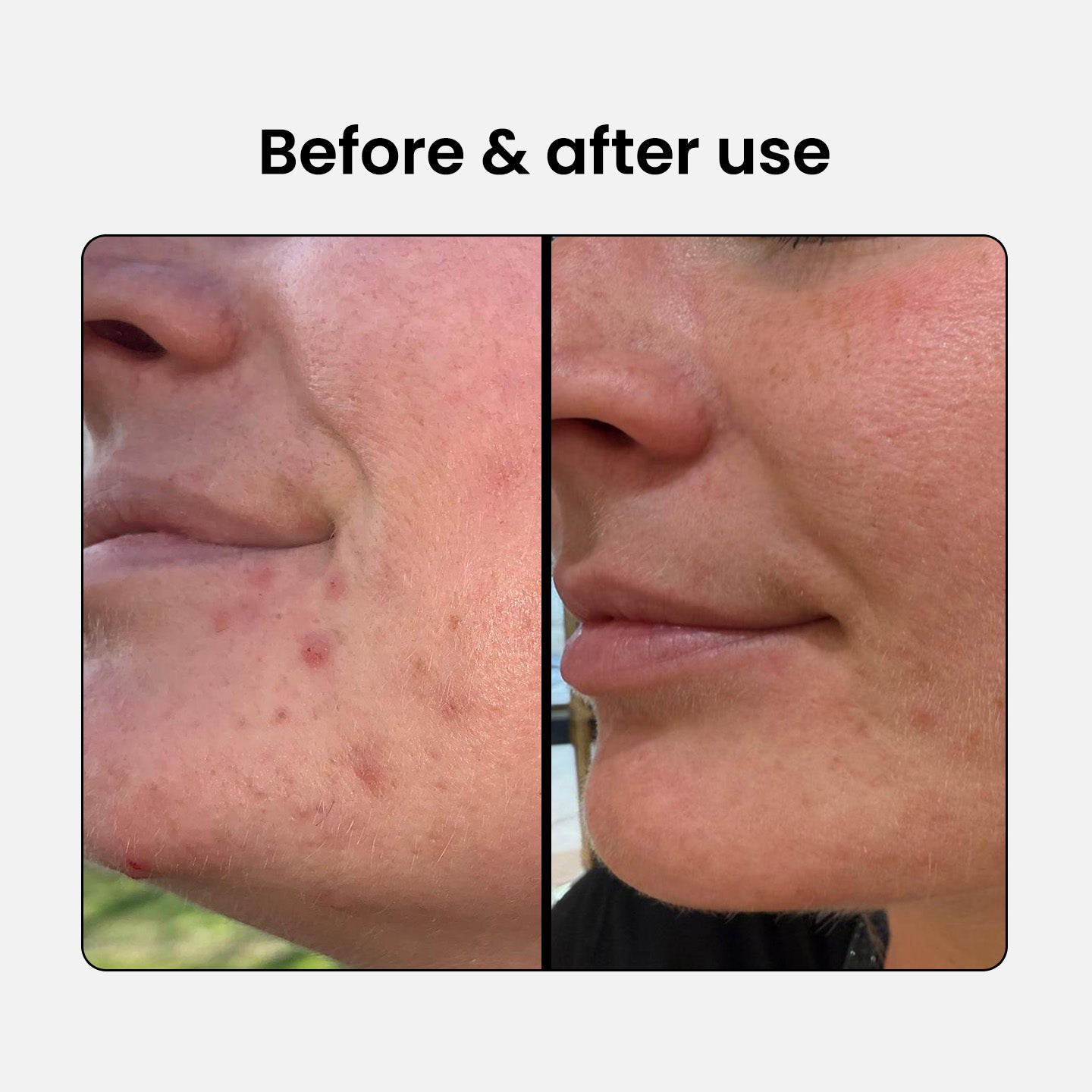 BHA Set: Cleanser + Lotion Exfoliant